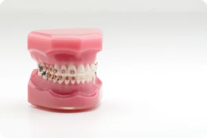 Le remboursement des soins orthodontiques